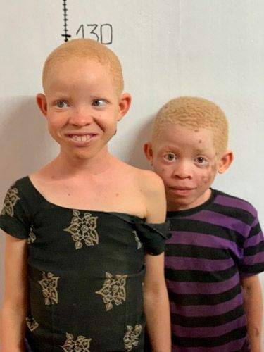 Albino children